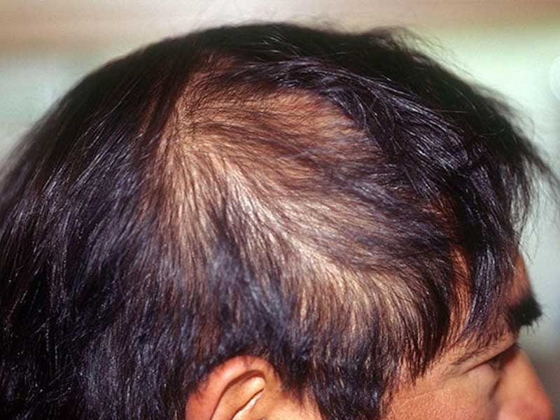 Hair loss Acute Telogen Effluvium symptom