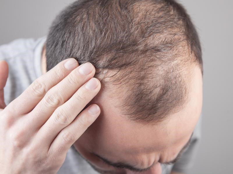 Telogen Effluvium in Men