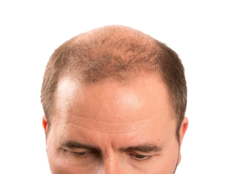 Telogen Effluvium Causes