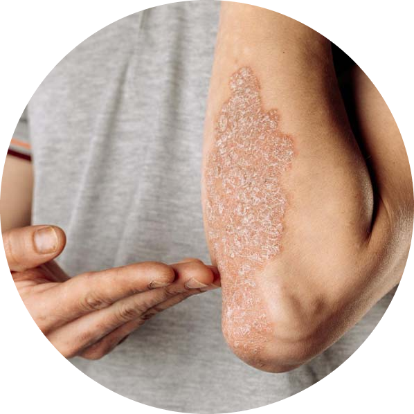 Symptoms of psoriasis