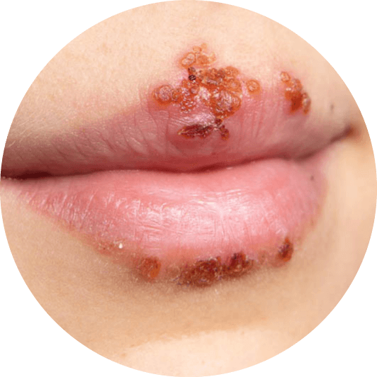HSV-1 symptoms around the lip