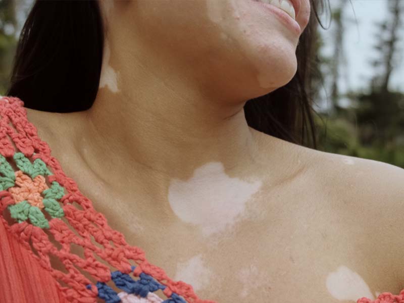 Vitiligo on body