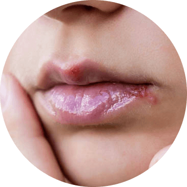 Herpes Blister on Lip