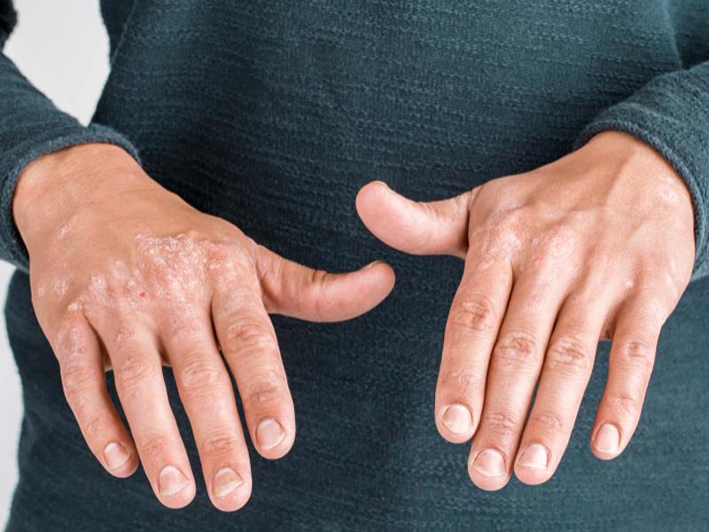 Symptoms of eczema