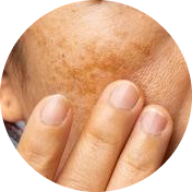 Menopause can Causes Melasma