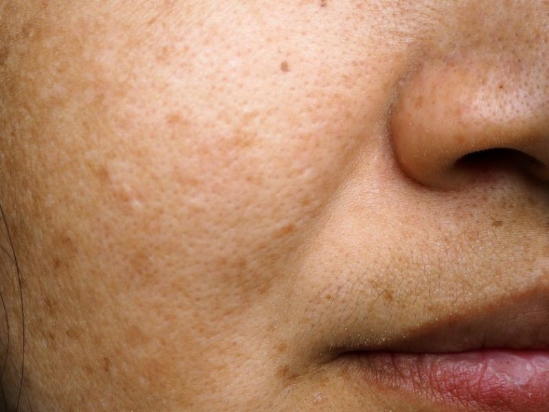 Pregnancy can cause Melasma