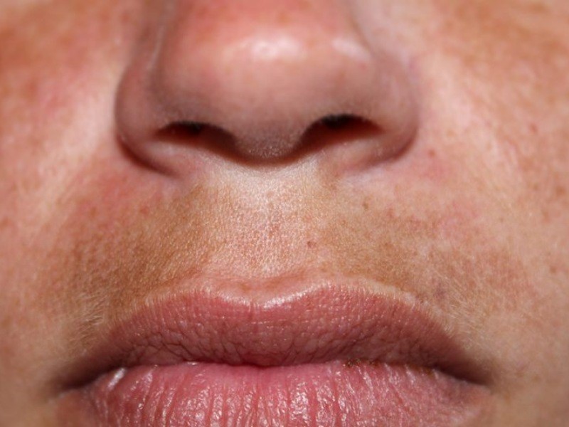 Melasma Mustache above the lip