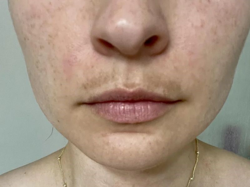 Melasma treatment options