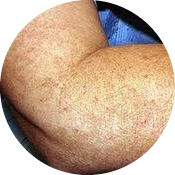 Melasma Prevention methods