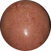 Melasma symptoms on the head