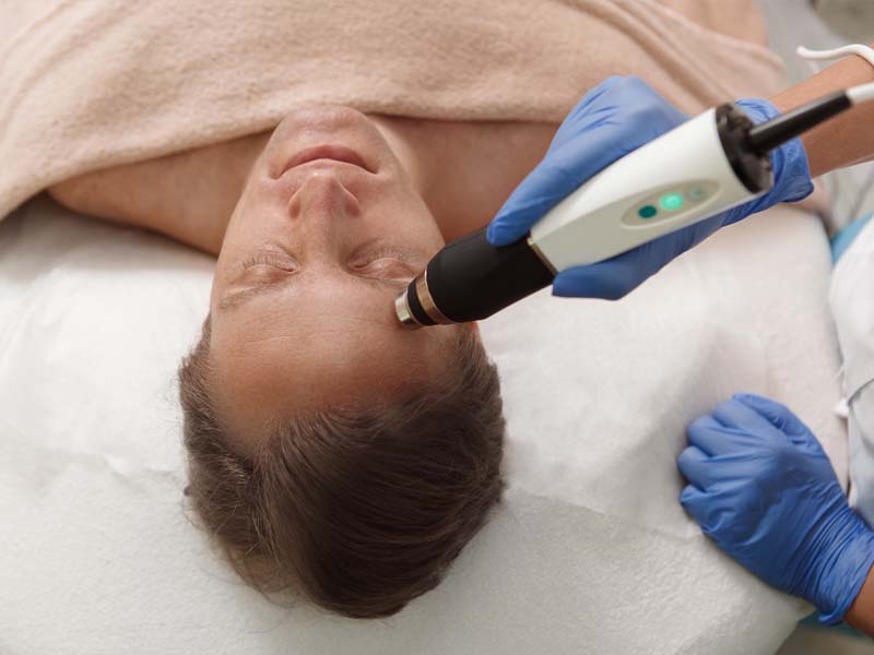 Sebaceous Hyperplasia Removal by laser