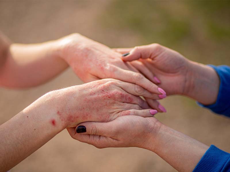 skin rash symptoms on hands