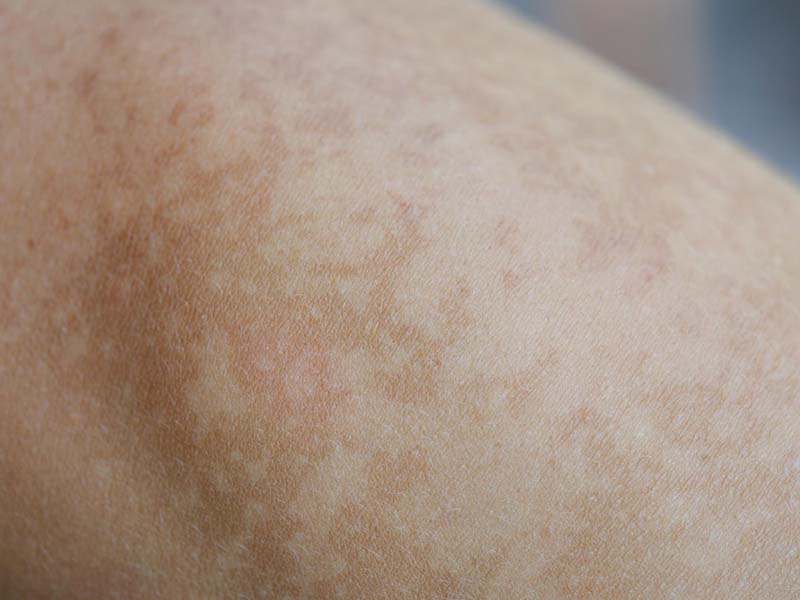 Loss of Pigment in Skin