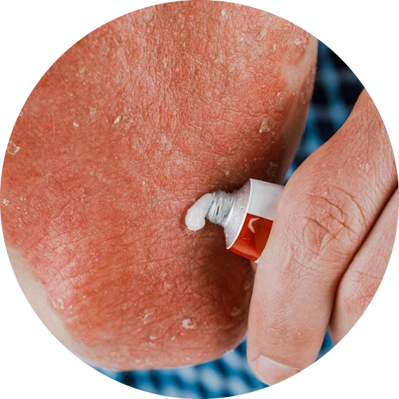 Ointment on psoriasis symptoms
