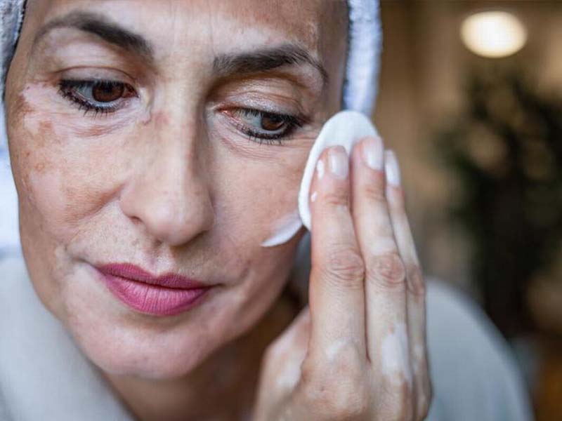 Topical Treatments for Vitiligo