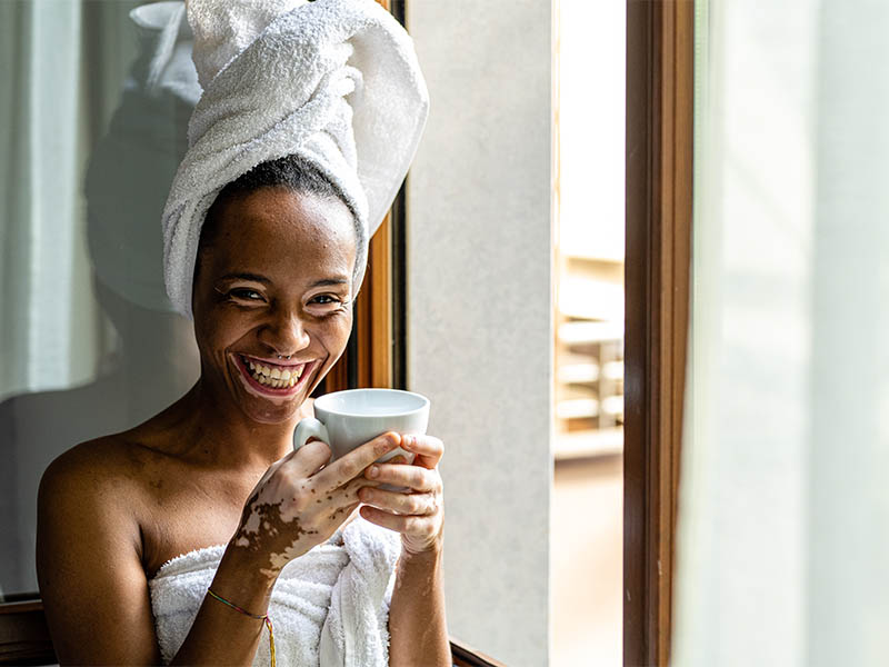 Woman with vitiligo