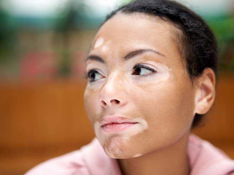 Vitiligo Symptoms