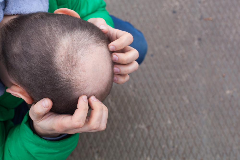 A Man With Androgenic Alopecia
