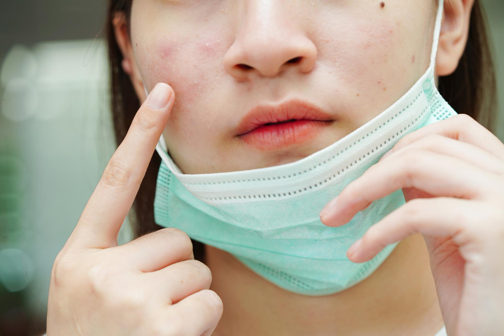 Chocolate and acne not connected