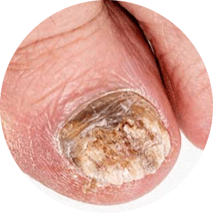 Nail fungus on the toenail