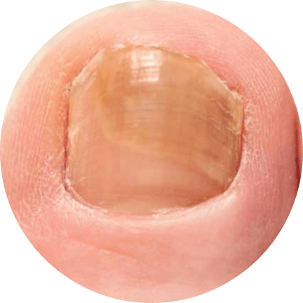 Symptoms of Nail Fungus