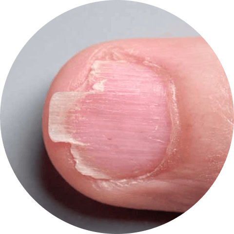 Nail fungus on the nail