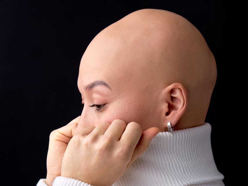 Woman with alopecia areata