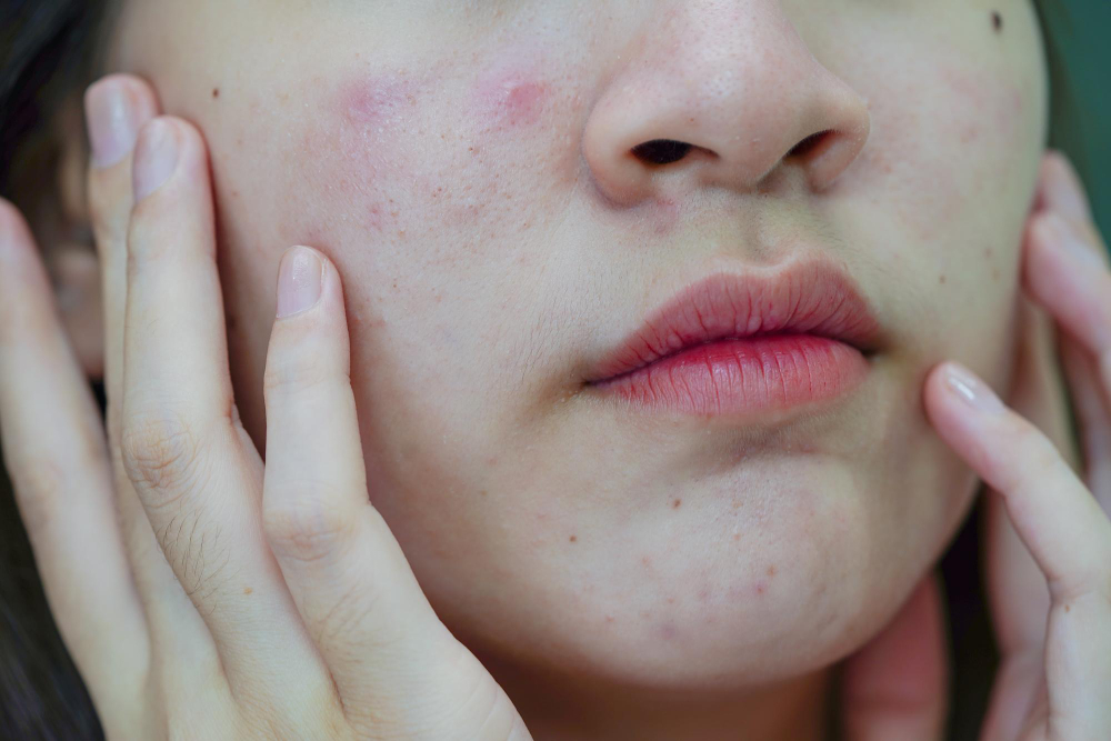 Common Symptoms of Blackheads