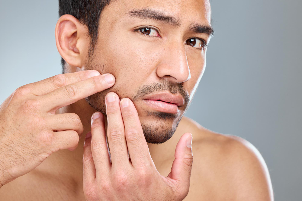 Touching face can cause blackheads