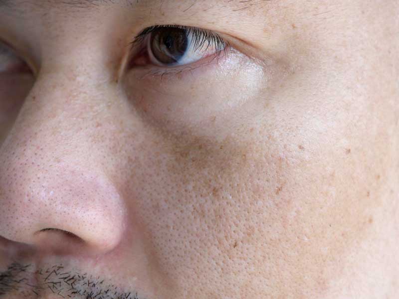 Close-up of melasma on cheek