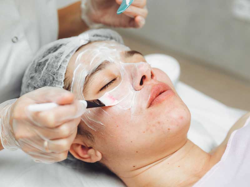 Applying chemical peels acne scars