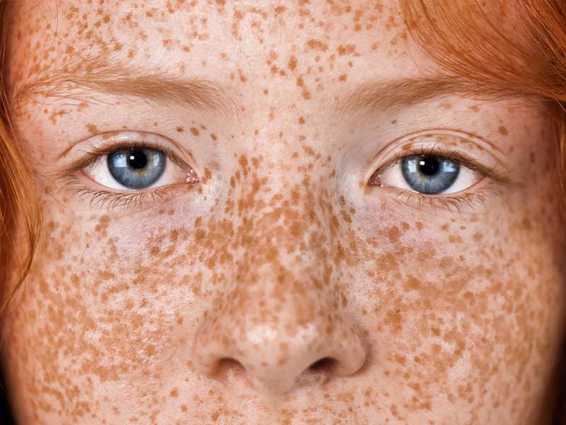 Dark spot (hyperpigmentation) on face