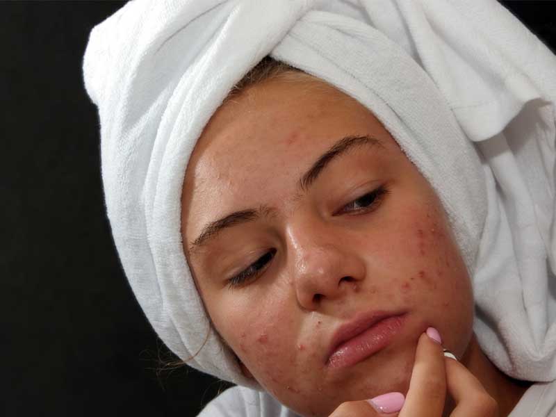 Woman with oily skin acne