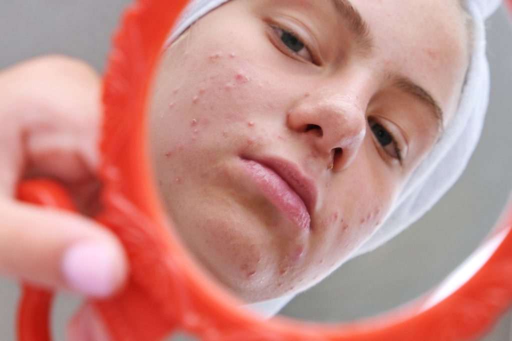 Causes of whitehead acne