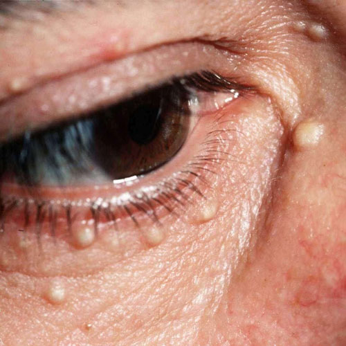 Different types of milia