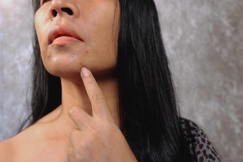 Junk Food and Acne Relationship