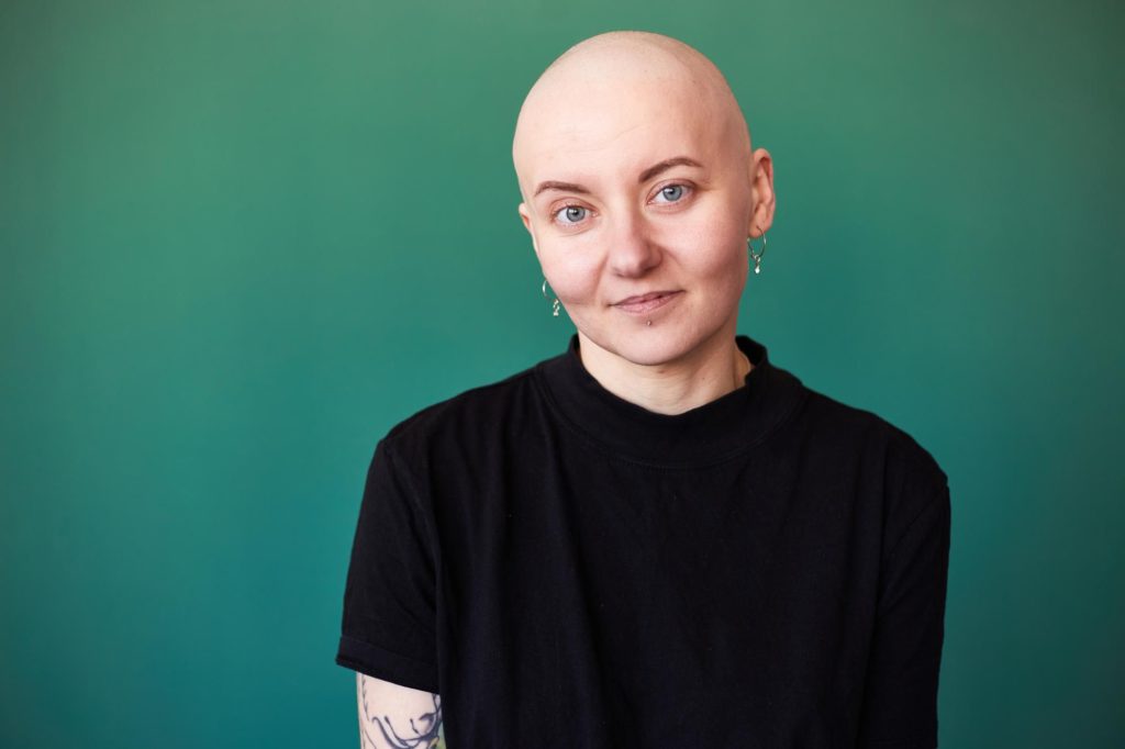 Symptoms of Alopecia Totalis