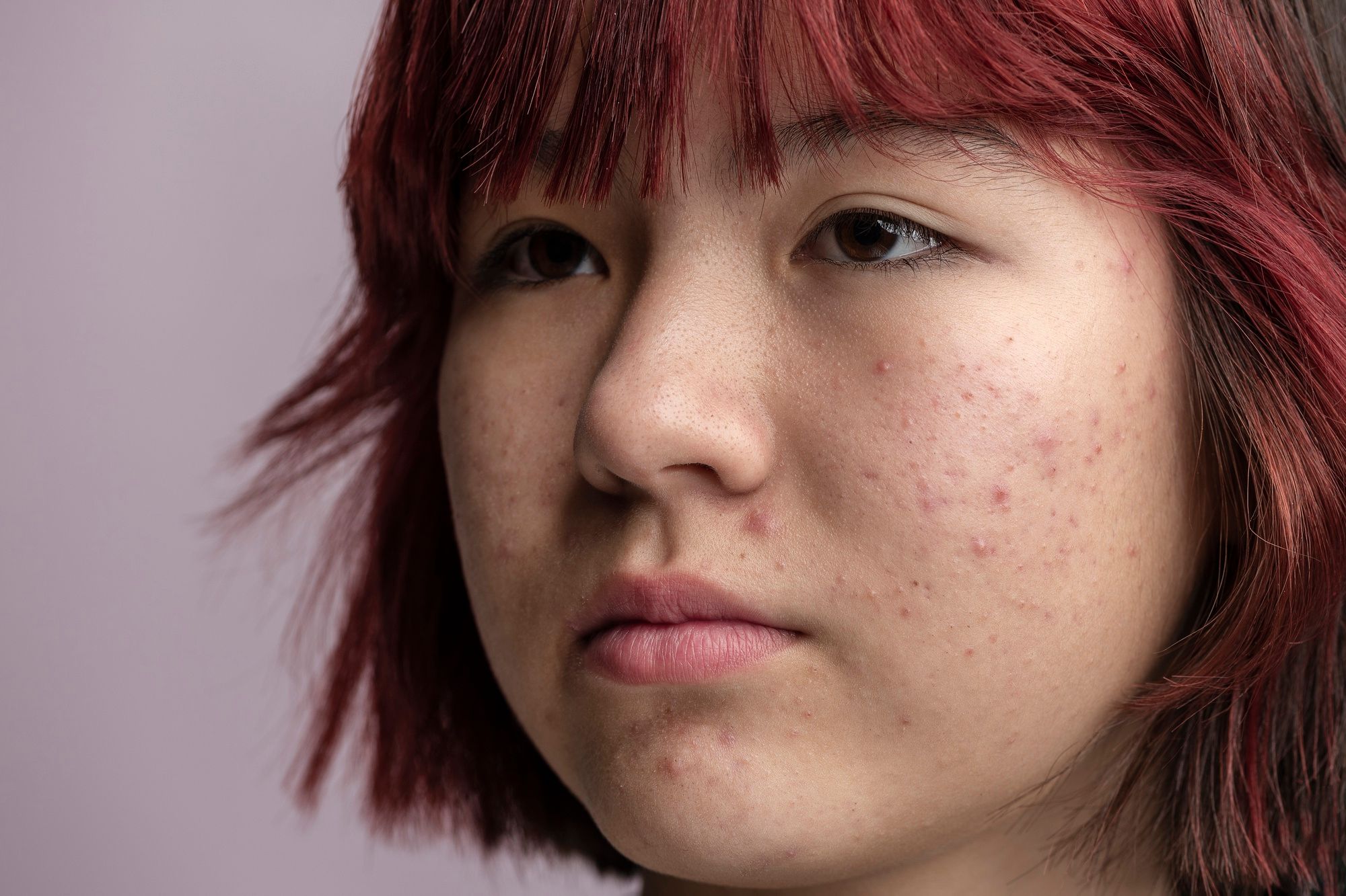 Whitehead acne on the forehead