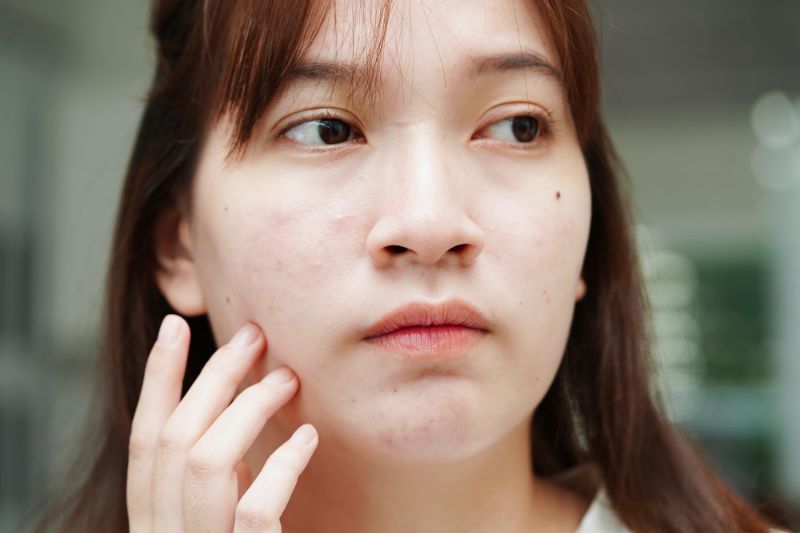 Woman with acne on face