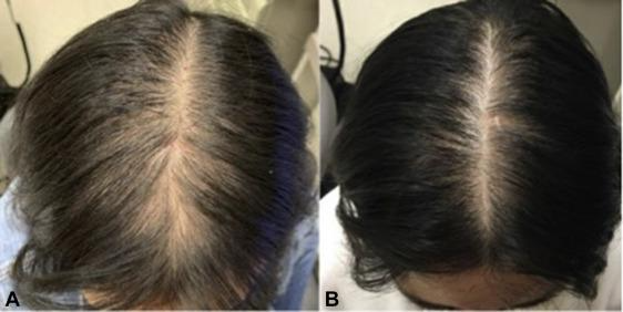 Treating female pattern alopecia