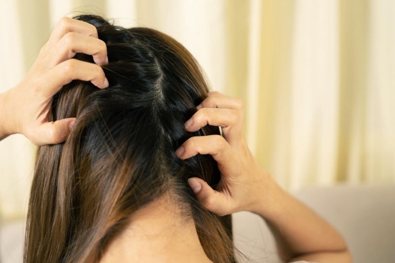 scalp psoriasis on head Symptoms 