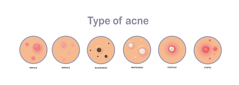 Acne vs pimple differences