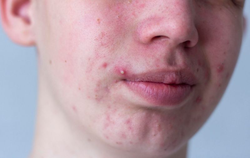 Different types of acne