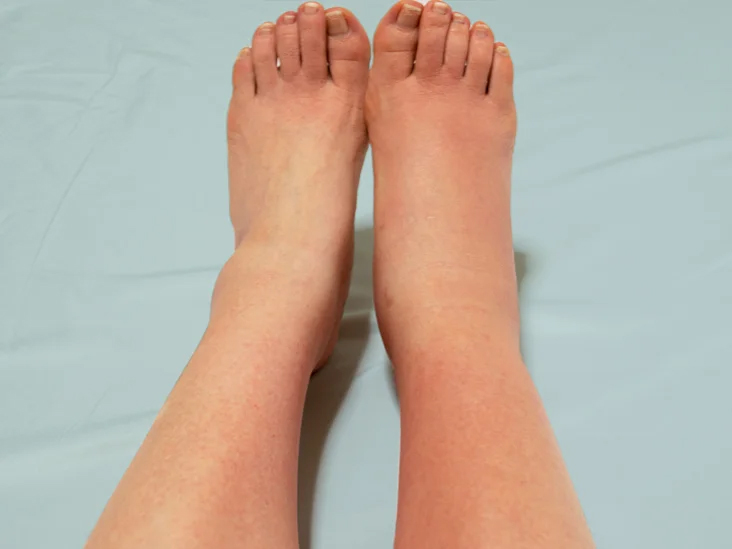 Recognizing Cellulitis Symptoms