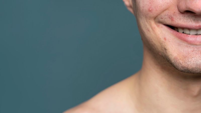 Understanding Acne