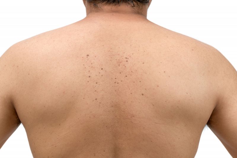 Understand and Treat Acne on Back