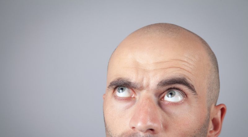 Understanding Male Pattern Baldness