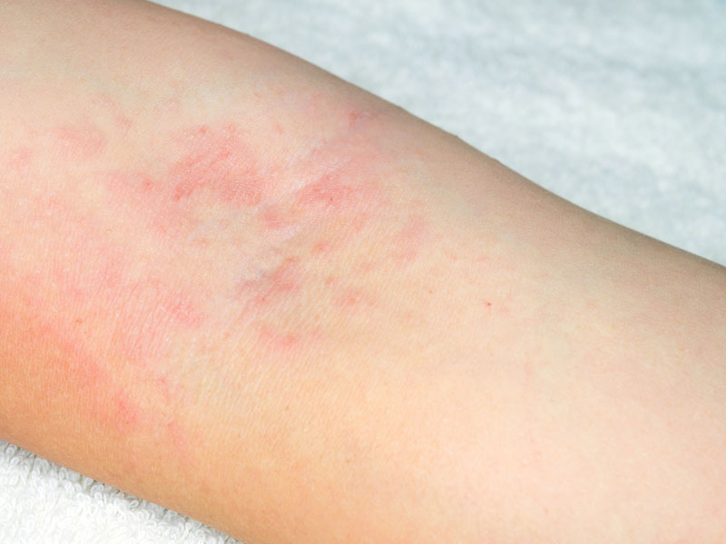 Symptoms of Bedbug Bites