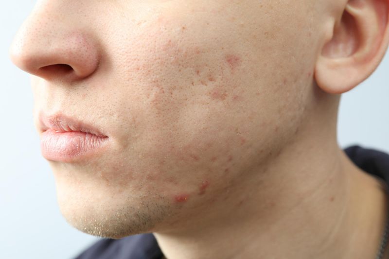 difference between acne vs pimples