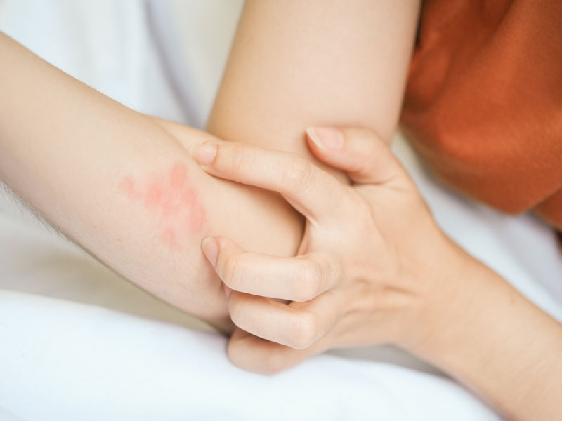 Contact Dermatitis Symptoms